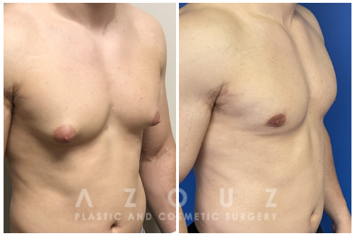 Gynecomastia in Bodybuilding: Causes, Prevention, and Solutions