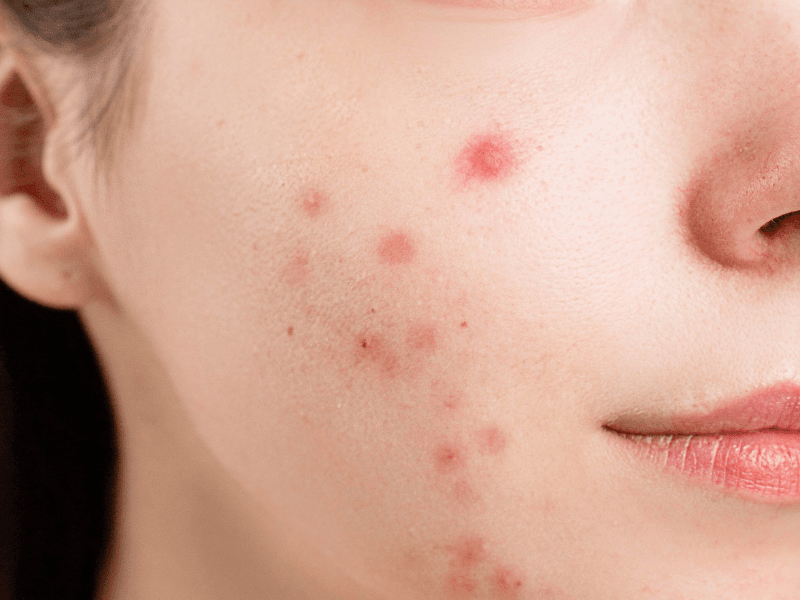 The relationship between anabolic steroids and acne